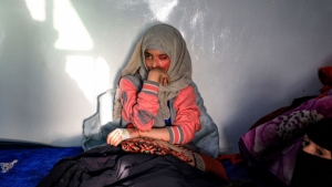 مأساة فتاة يمنية أحرقها زوجها بالأسيد وهو يضحك
