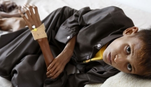 &quot;حسن محمد&quot;.. قصة طفل يفترسه سوء التغذية في صنعاء