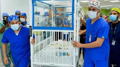 أكثر من 25 طبيبا يجرون عملية فصل التوأم الطفيلي اليمني في السعودية