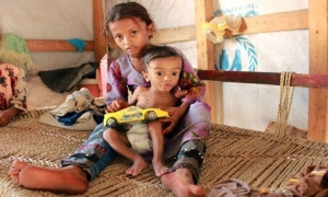 والد طفلة يمنية مصابة بسوء التغذية.. تركتها تتألم وحيدة بسبب الظروف