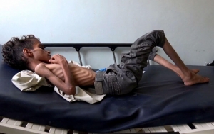 هكذا يفترس الجوع والمرض أجساد أطفال اليمن في الأرياف