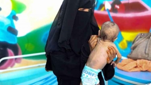 تقرير أممي: سوء التغذية يهدد أكثر من 2 مليون طفل في اليمن