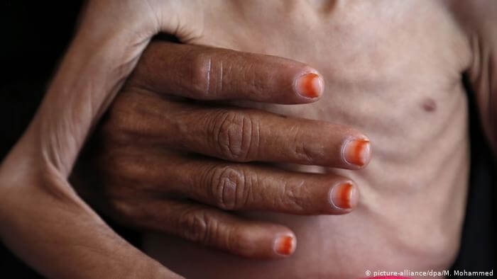 تقرير دولي يدق أجراس الخطر.. اليمن مهدد بأسوأ مجاعة على مستوى العالم