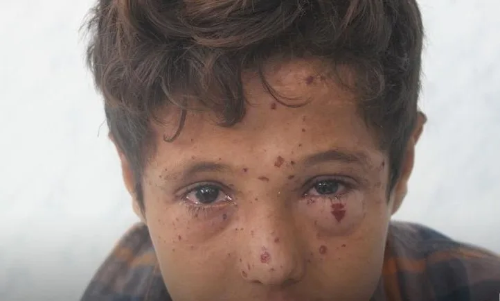 اليمن.. مقتل وإصابة 14 مدنيا بالألغام ومخلفات الحرب خلال 48 ساعة