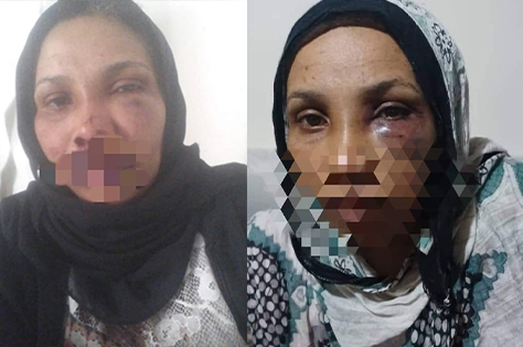 تعز.. نافذ يعتدي على مواطنة مهمشة بالضرب محاولا إجبارها على التخلي عن منزلها